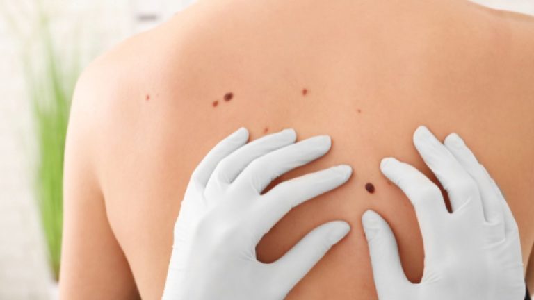 Câncer de pele não melanoma afeta 180 mil pessoas em três anos