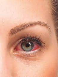 Trauma ocular pode causar glaucoma e levar à cegueira