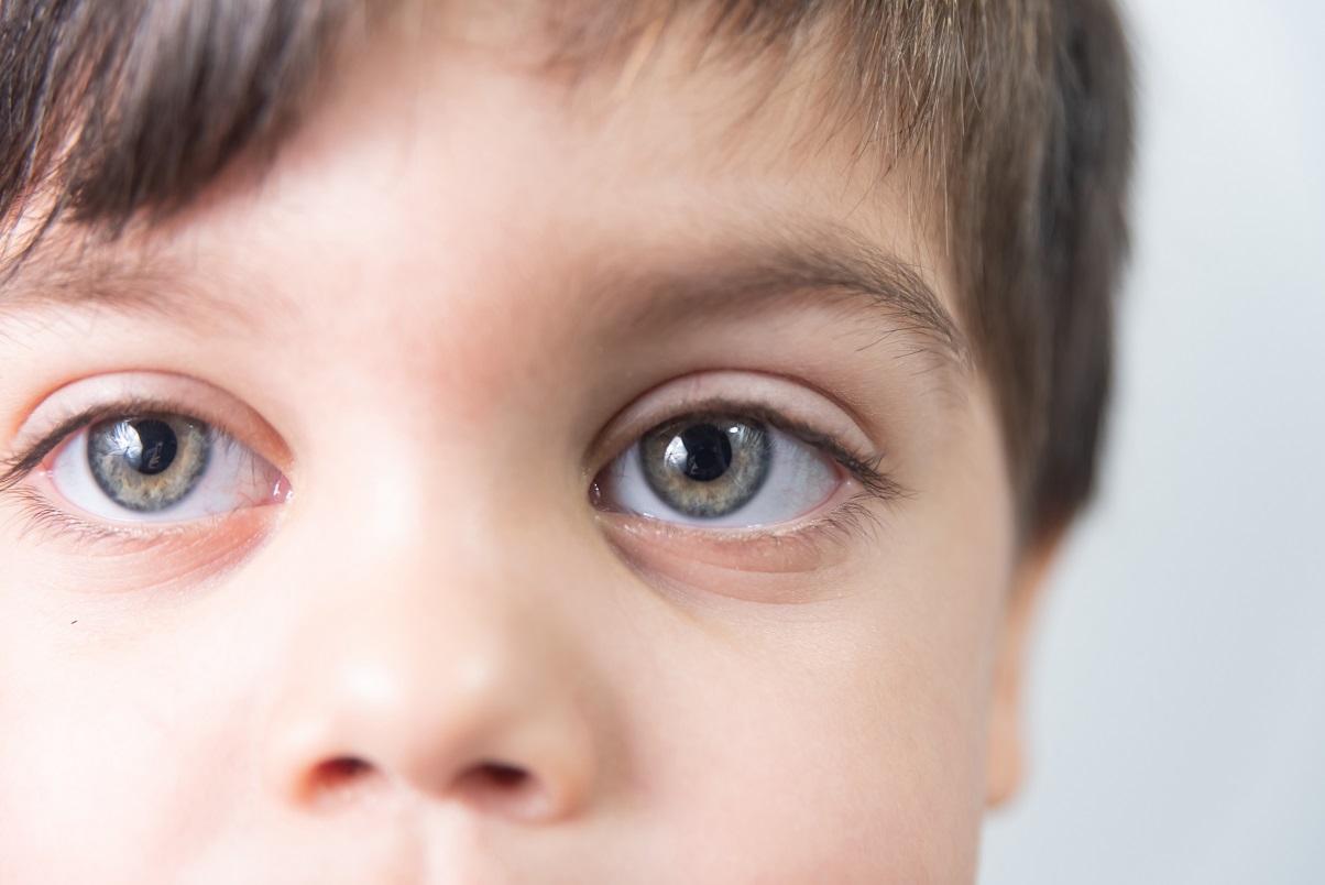 Controle da miopia na infância é fundamental para prevenir danos na visão ao longo da vida